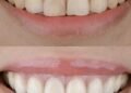 The gummy smile: A hidden sign of mouth breathing | Lifestyles