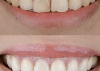 The gummy smile: A hidden sign of mouth breathing | Lifestyles