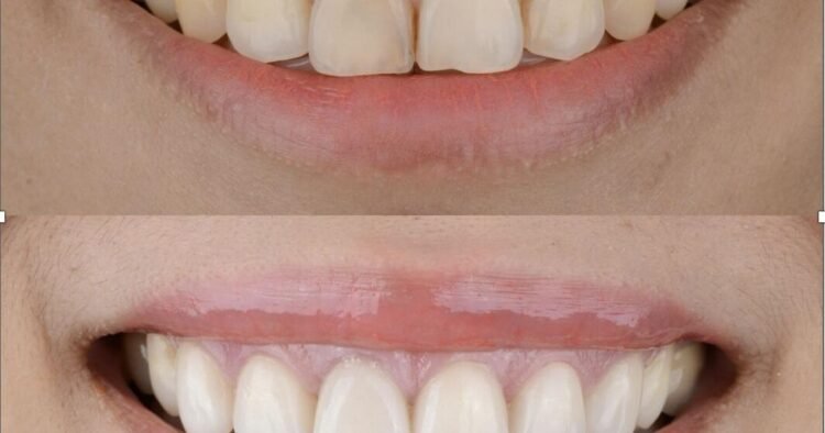 The gummy smile: A hidden sign of mouth breathing | Lifestyles