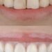 The gummy smile: A hidden sign of mouth breathing | Lifestyles