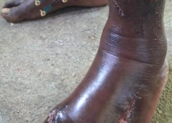 Union calls for action after worker injury | News