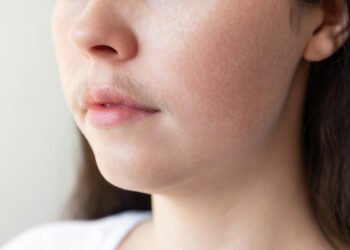 Female facial hair: causes and effective methods of removal