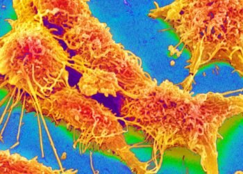 Colon cancer: You shouldn’t ignore these symptoms