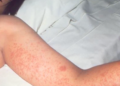 Barbados records increase in measles coverage