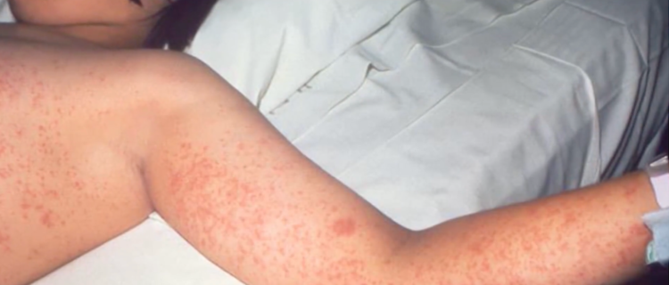 Barbados records increase in measles coverage