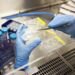 Stem cell transplant achieves cure for HIV