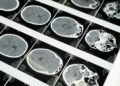 Following deadly UK outbreak: Protecting yourself against meningitis in Luxembourg