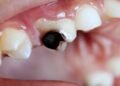 Rampant tooth decay in adults can be avoided | Lifestyles