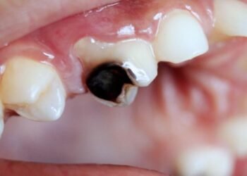 Rampant tooth decay in adults can be avoided | Lifestyles