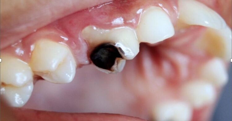 Rampant tooth decay in adults can be avoided | Lifestyles