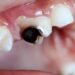 Rampant tooth decay in adults can be avoided | Lifestyles