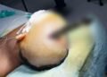 Knife removed from teen’s brain