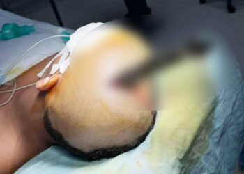 Knife removed from teen’s brain