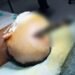 Knife removed from teen’s brain