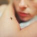 The deadly disease returns with travelers: 10 cases of malaria were recorded in Lithuania last year