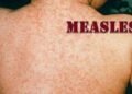Belize records case of measles after person visits Guatemala