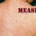 Belize records case of measles after person visits Guatemala