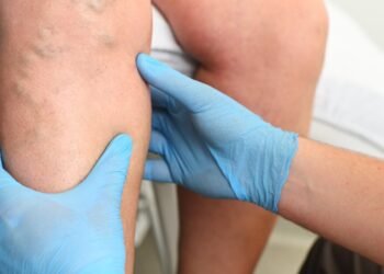 Named the first signs of varicose veins: many do not even suspect that they are sick