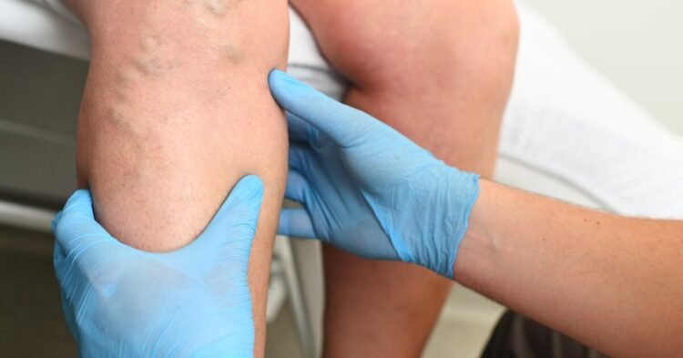 Named the first signs of varicose veins: many do not even suspect that they are sick