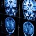 Women with traumatic brain injury 26 per cent less likely to receive trauma care than men, Ontario study finds