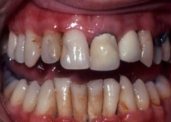 Every puff leaves a scar: The hidden damage smoking, vaping, and marijuana cause to your mouth and body | Lifestyles