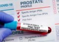 Before prostate cancer speaks, PSA often whispers | Lifestyles