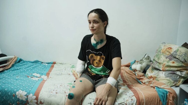 The rescuer told about the attack on Kharkiv, when she lost her arm