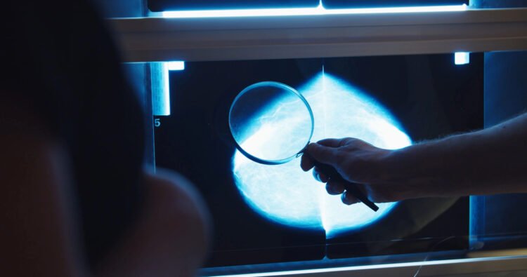 Test which spares breast cancer sufferers chemo not used enough
