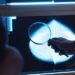 Test which spares breast cancer sufferers chemo not used enough