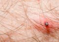 Spring weather leads to a surge in tick bites nationwide