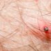 Spring weather leads to a surge in tick bites nationwide