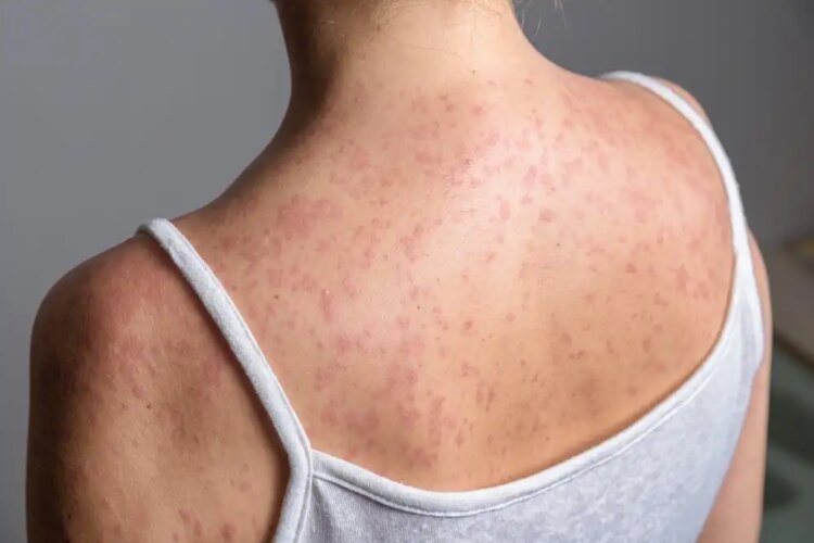 Five months of outbreak: measles leaves 22 dead and 16,840 cases in Guatemala
