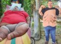 Guatemalan who lost more than 500 pounds seeks to remove excess skin