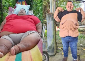 Guatemalan who lost more than 500 pounds seeks to remove excess skin