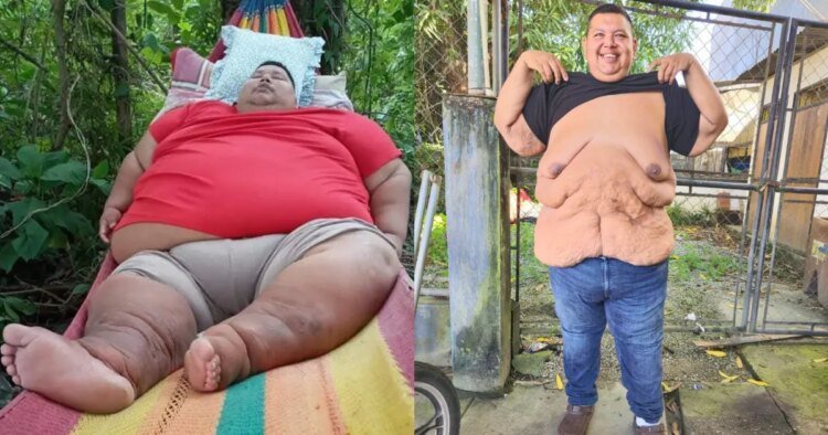 Guatemalan who lost more than 500 pounds seeks to remove excess skin