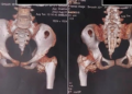 Rare stone man syndrome diagnosed in 12-year-old girl in Ho Chi Minh City