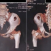 Rare stone man syndrome diagnosed in 12-year-old girl in Ho Chi Minh City