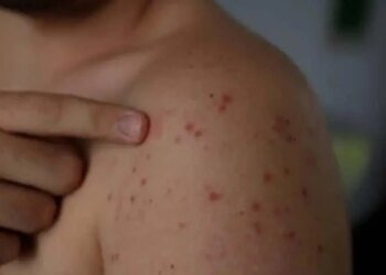 Honduras confirms third imported case of measles in Omoa, Cortés
