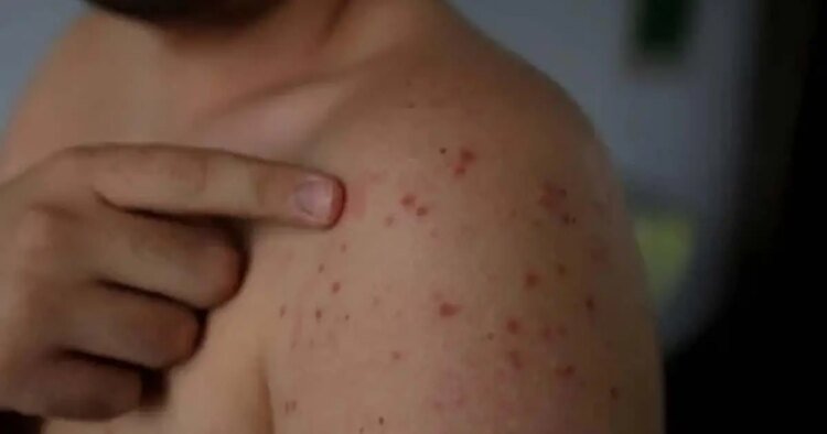 Honduras confirms third imported case of measles in Omoa, Cortés