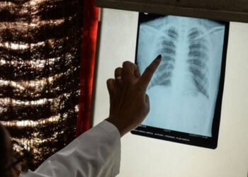 Upcoming launch of a study: The catastrophic costs associated with tuberculosis under the microscope of the ministry – Today Morocco