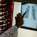 Upcoming launch of a study: The catastrophic costs associated with tuberculosis under the microscope of the ministry – Today Morocco