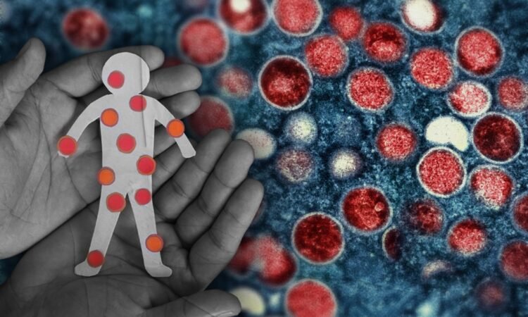 Mpox case confirmed in Mandaluyong; contact tracing launched