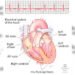 Is your heart racing or skipping beats? Learn when it could be an arrhythmia