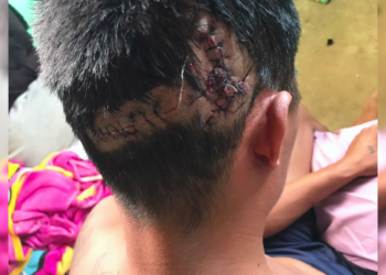 Guinea Grass Man Survives Crocodile Attack at New River Park