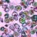 Pennsylvania woman dies of measles-related complications, local coroner says