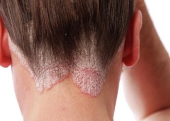 The doctor told how to recognize psoriasis and why you should not self-medicate