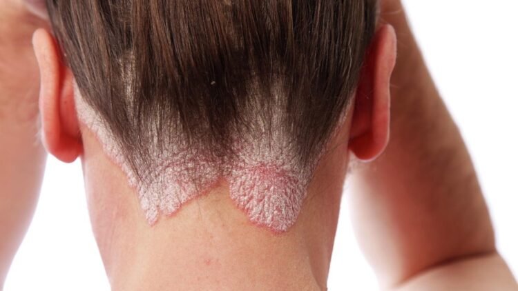 The doctor told how to recognize psoriasis and why you should not self-medicate