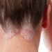 The doctor told how to recognize psoriasis and why you should not self-medicate