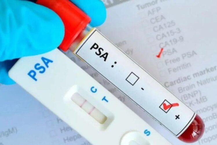Minsa clarifies that a high PSA does not necessarily mean prostate cancer